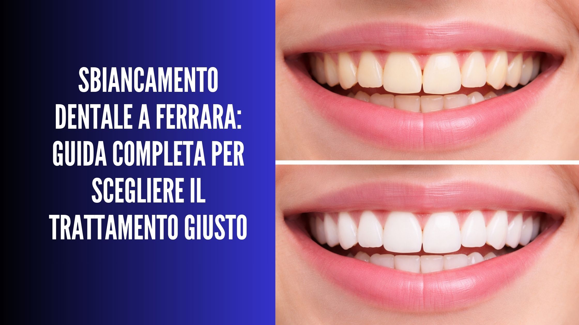 Confronto di due sorrisi: denti prima e dopo sbiancamento dentale con tonalità più chiara