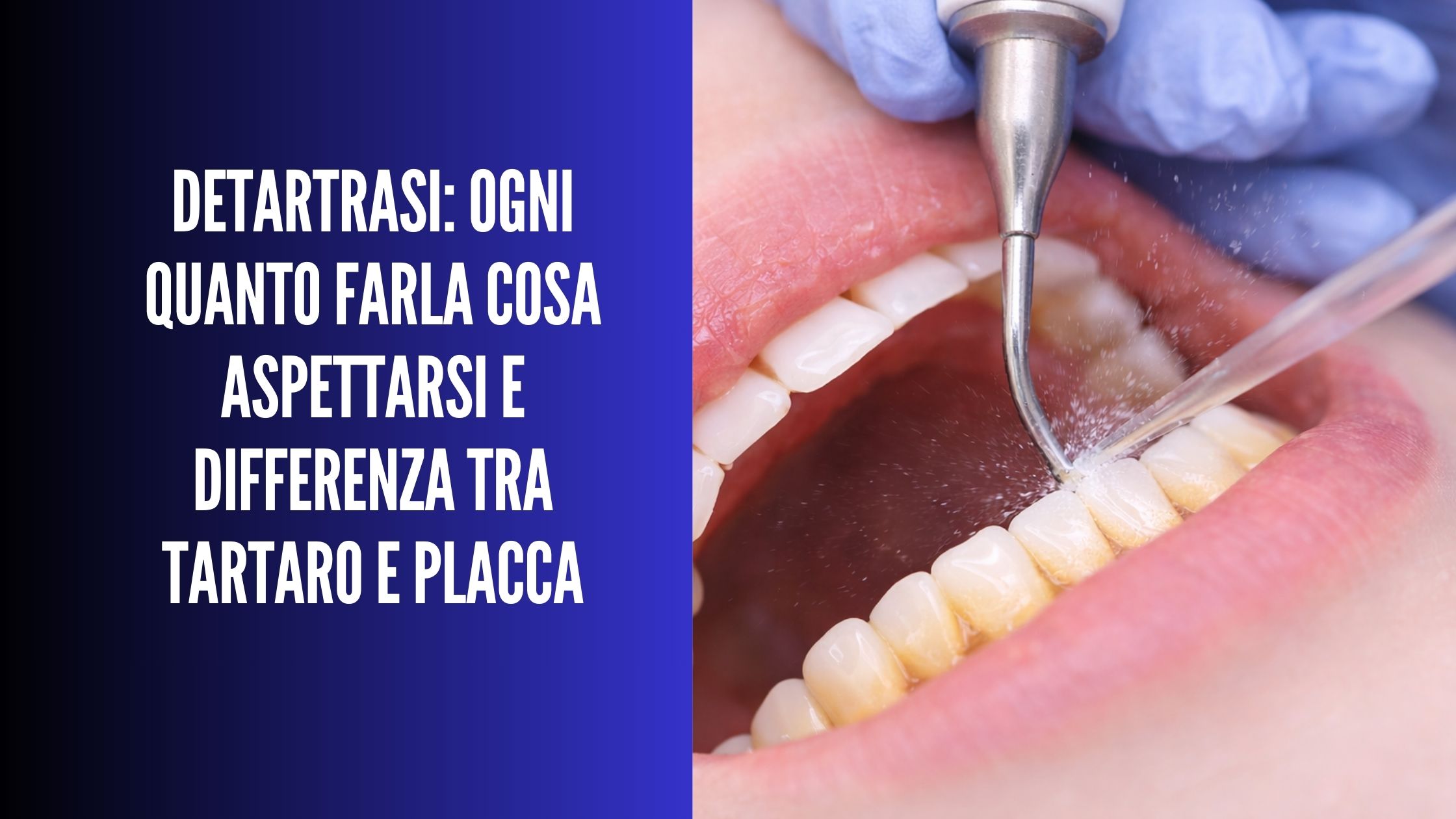 Detartrasi con ablatore ad ultrasuoni: rimozione del tartaro durante igiene orale professionale