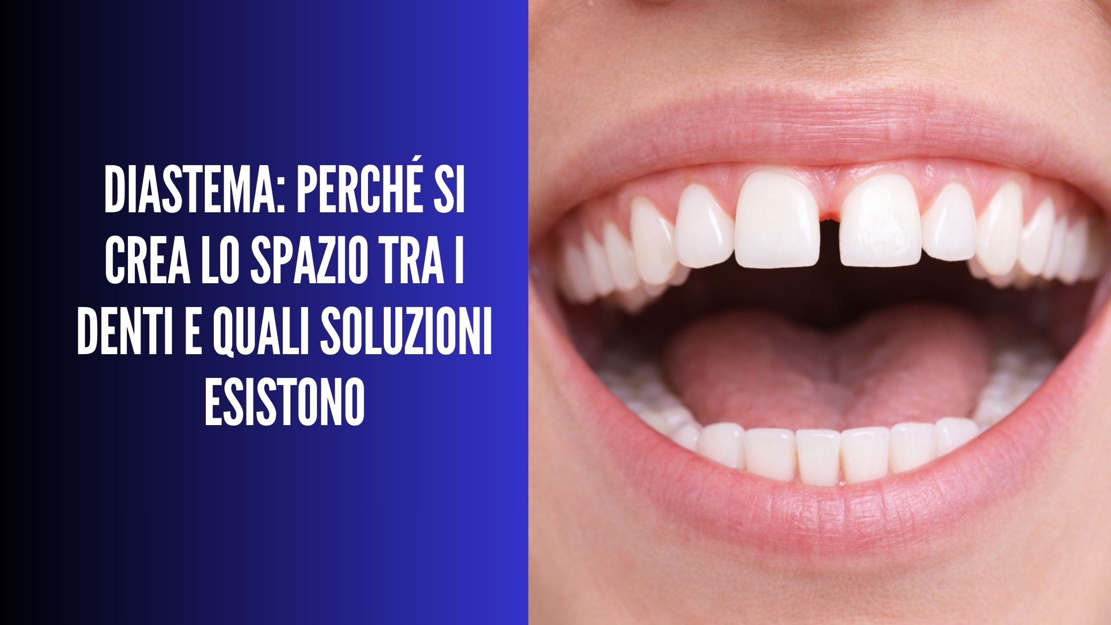 Sorriso a bocca aperta con diastema visibile tra gli incisivi superiori centrali