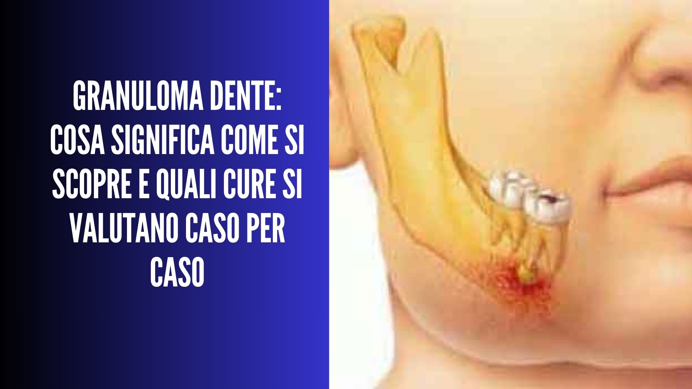 Illustrazione di granuloma dentale con dolore localizzato alla mandibola su volto di profilo