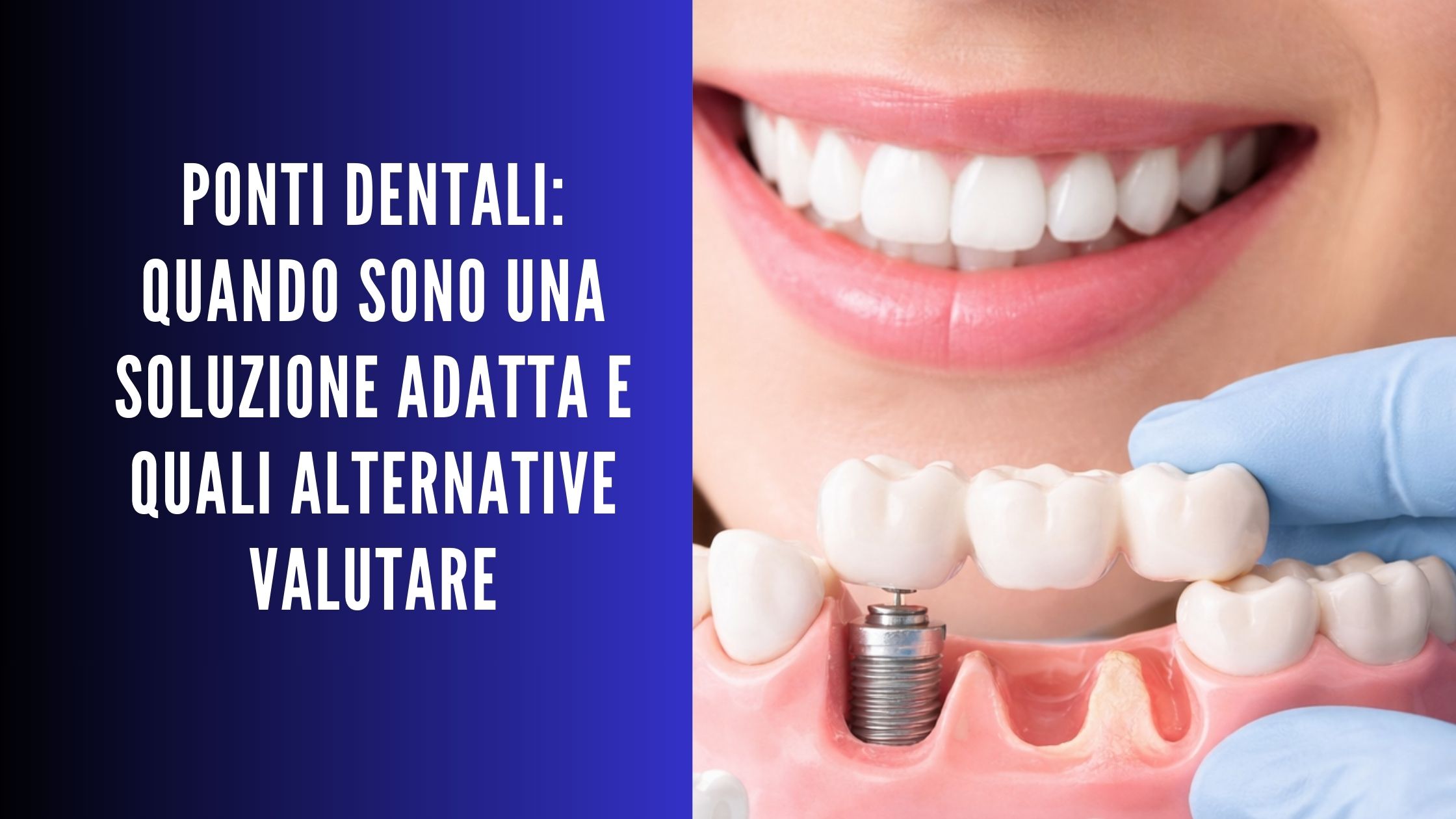 Sorriso e modellino dentale: mano con guanto inserisce un ponte dentale su uno spazio mancante